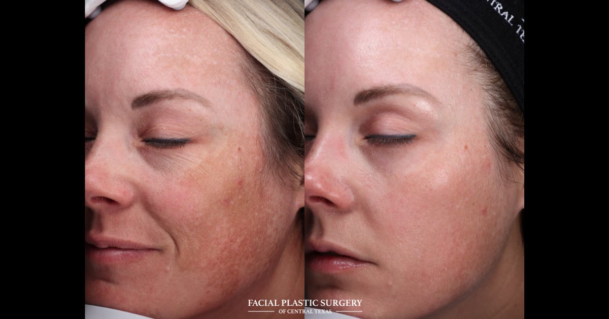 Laser Before & After Gallery - Patient 271711 - Image 3
