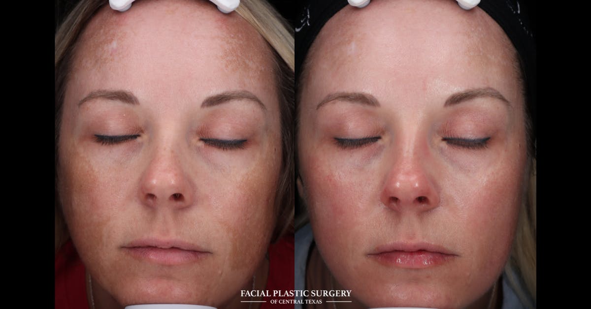 Laser Before & After Gallery - Patient 271711 - Image 1
