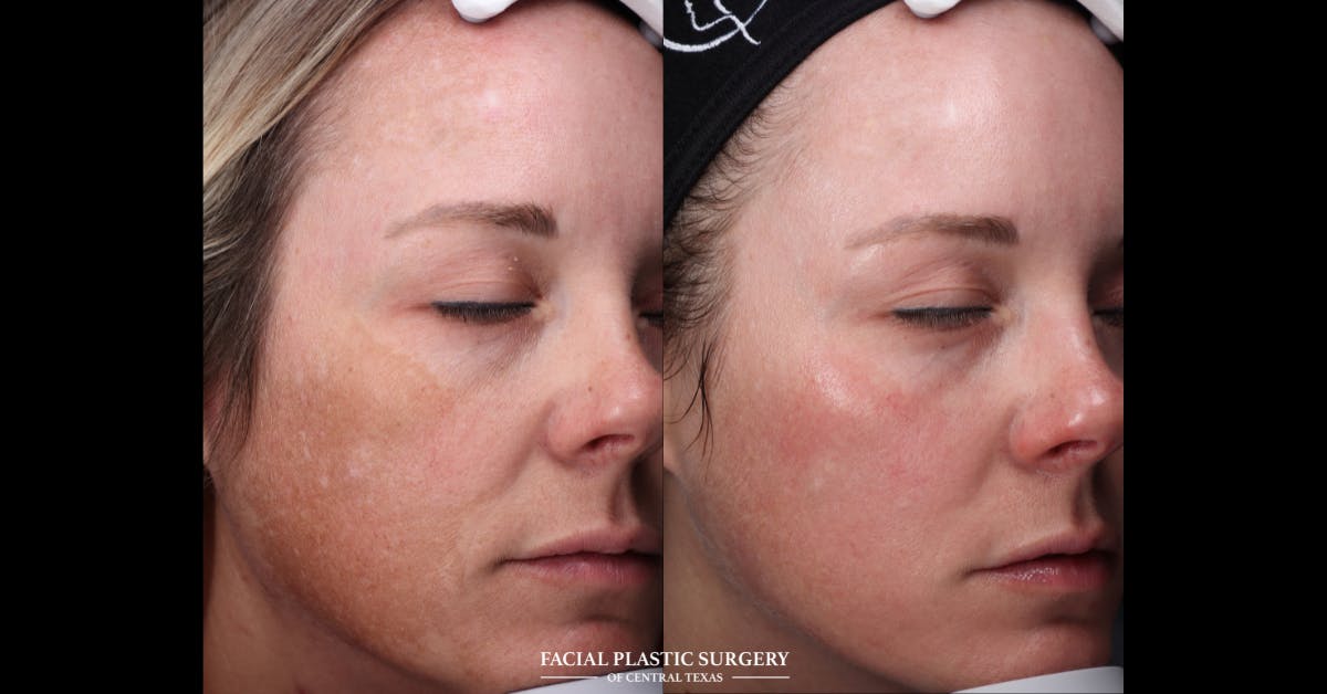 Laser Before & After Gallery - Patient 271711 - Image 2