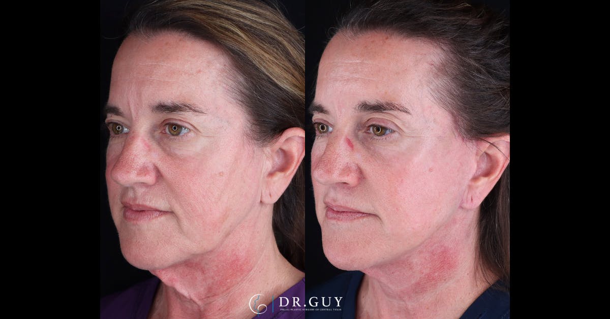 Mini Facelift Before & After Gallery - Patient 210607 - Image 3