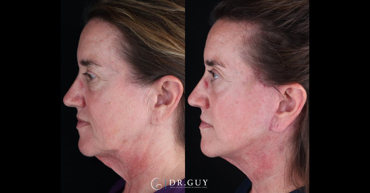 Mini Facelift Before & After Gallery - Patient 210607 - Image 4