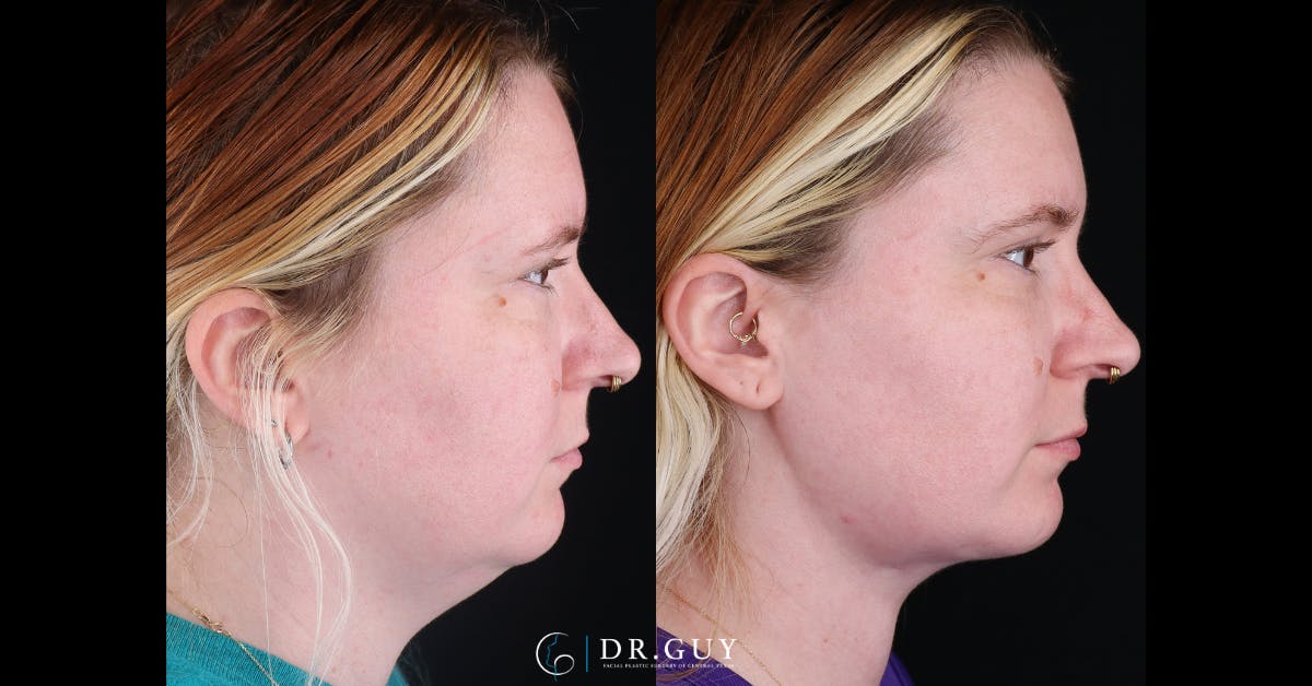 Neck Liposuction Before & After Gallery - Patient 423310 - Image 1