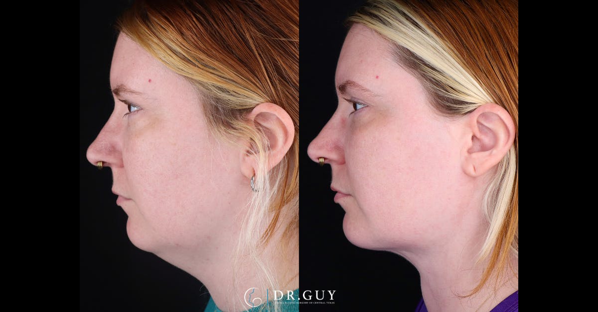 Neck Liposuction Before & After Gallery - Patient 423310 - Image 2