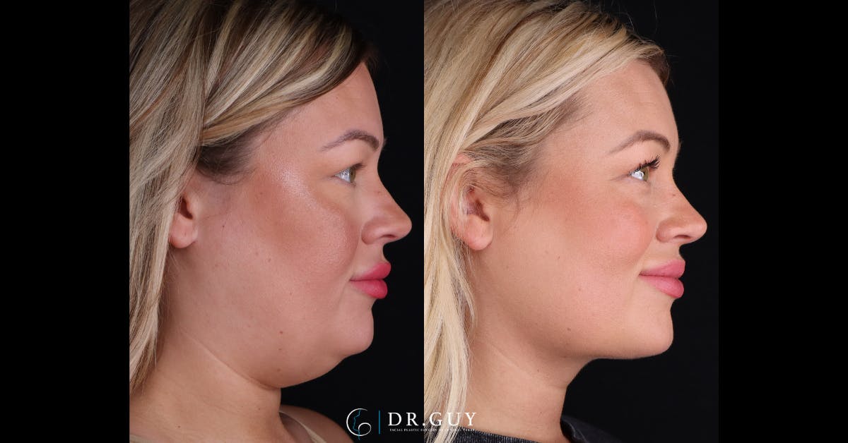 Neck Lift Before & After Gallery - Patient 344329 - Image 3