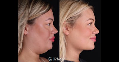 Platysmaplasty Before & After Gallery - Patient 111150 - Image 1