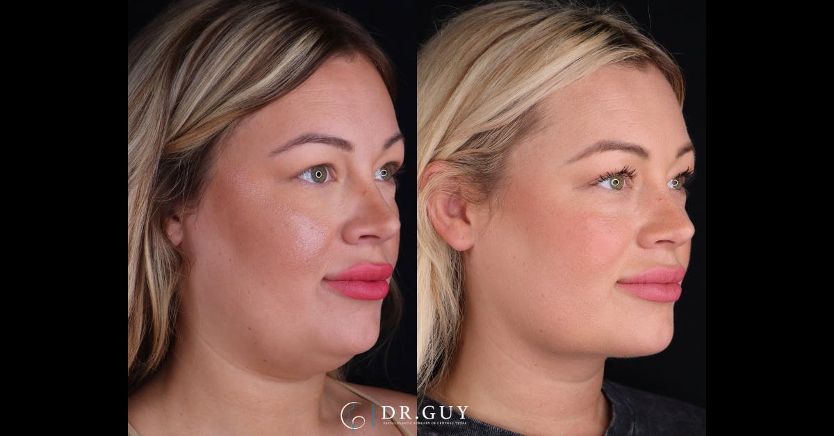 Neck Lift Before & After Gallery - Patient 344329 - Image 2