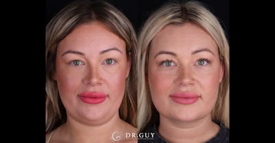 Neck Lift Before & After Gallery - Patient 344329 - Image 1