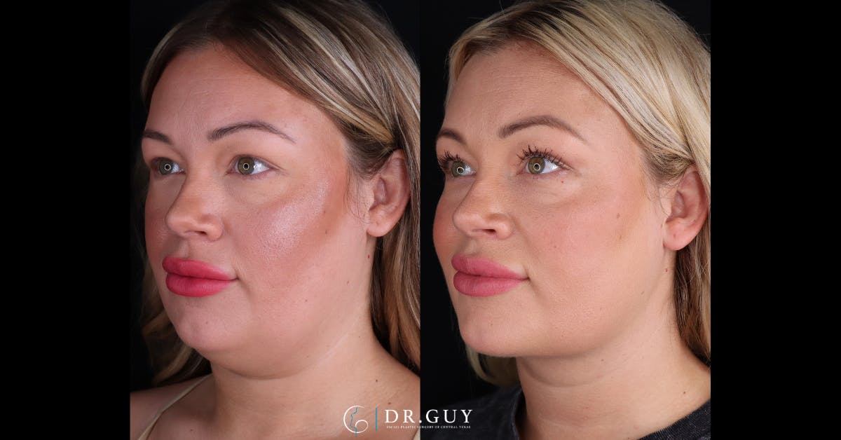 Neck Lift Before & After Gallery - Patient 344329 - Image 4