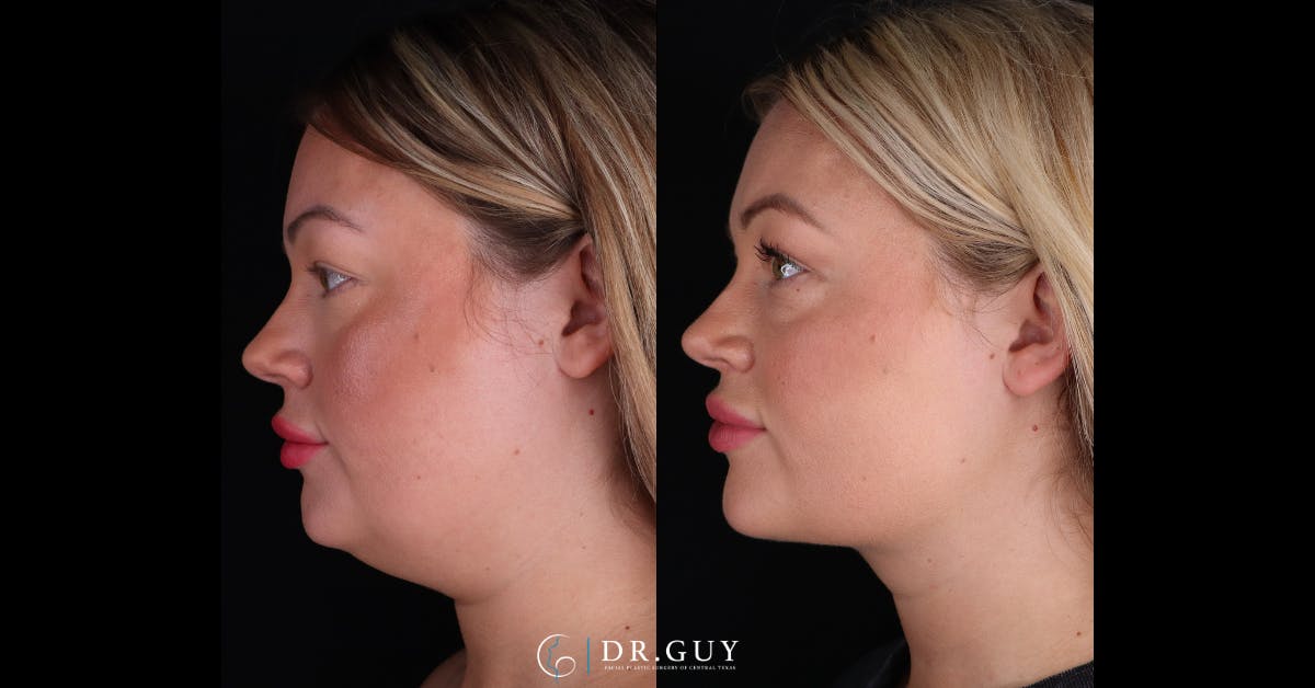 Neck Lift Before & After Gallery - Patient 344329 - Image 5