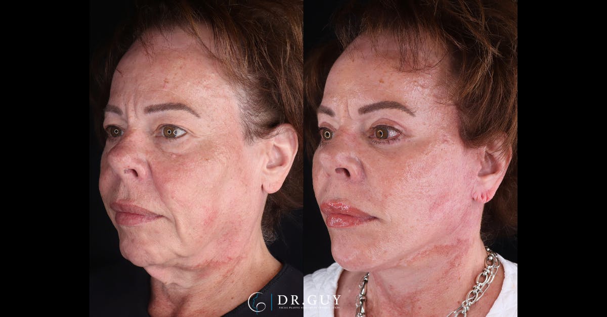 Lower Blepharoplasty Before & After Gallery - Patient 373891 - Image 3