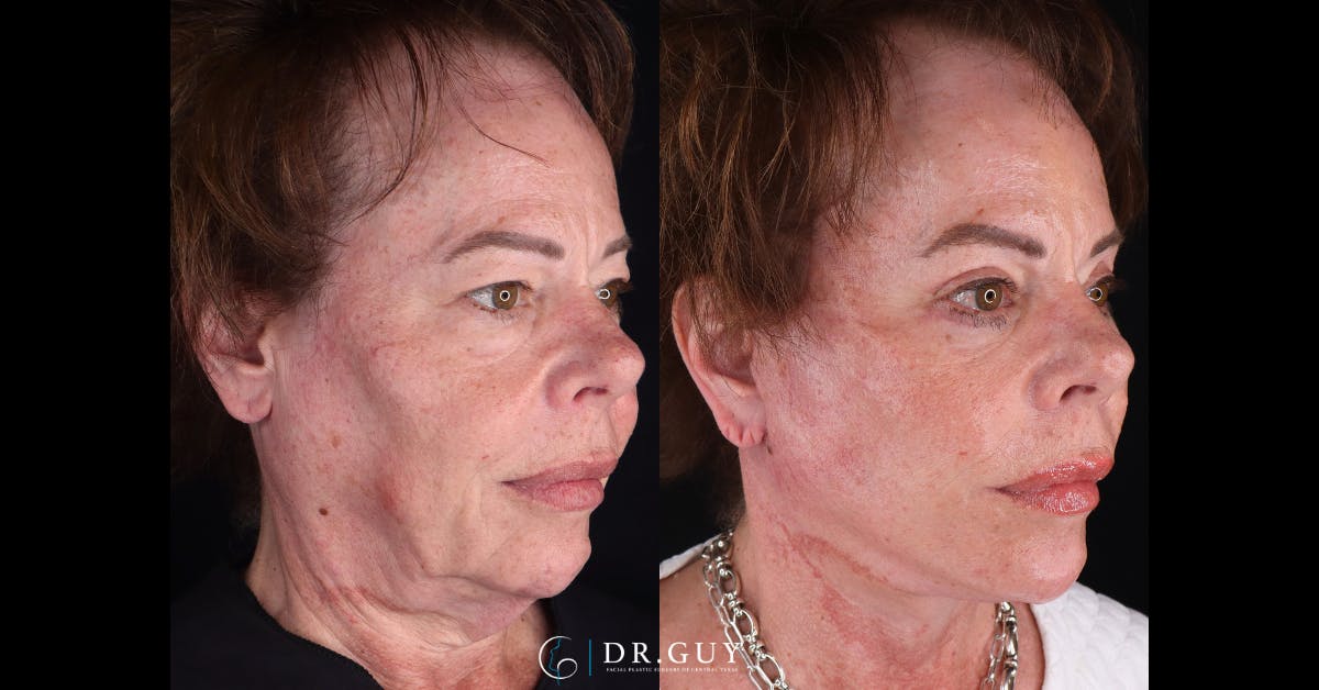 Lower Blepharoplasty Before & After Gallery - Patient 373891 - Image 2