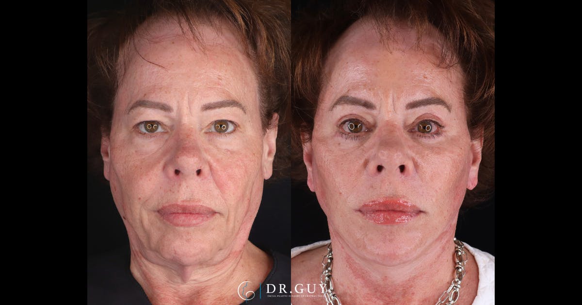 Lower Blepharoplasty Before & After Gallery - Patient 373891 - Image 1