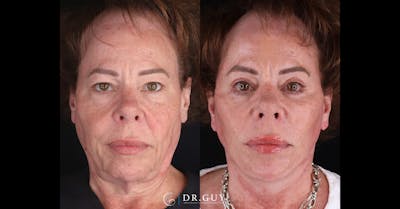 Upper Blepharoplasty Before & After Gallery - Patient 307044 - Image 1