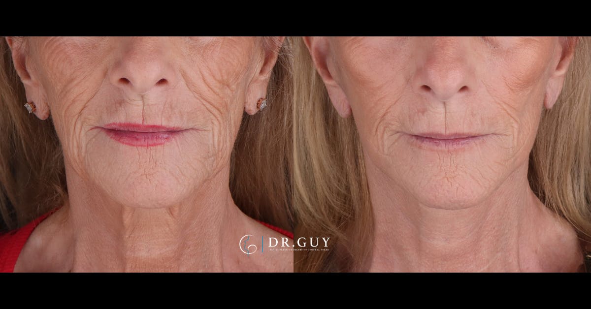Mini Facelift Before & After Gallery - Patient 155093 - Image 1