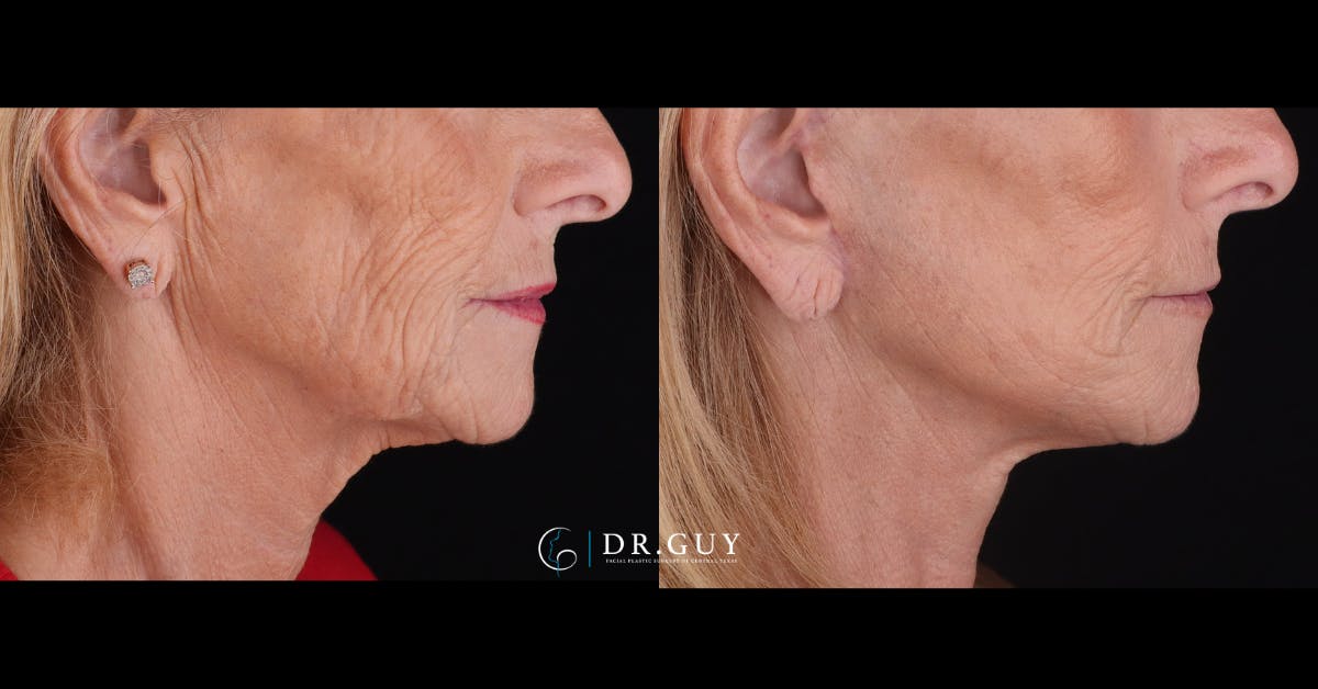 Mini Facelift Before & After Gallery - Patient 155093 - Image 3