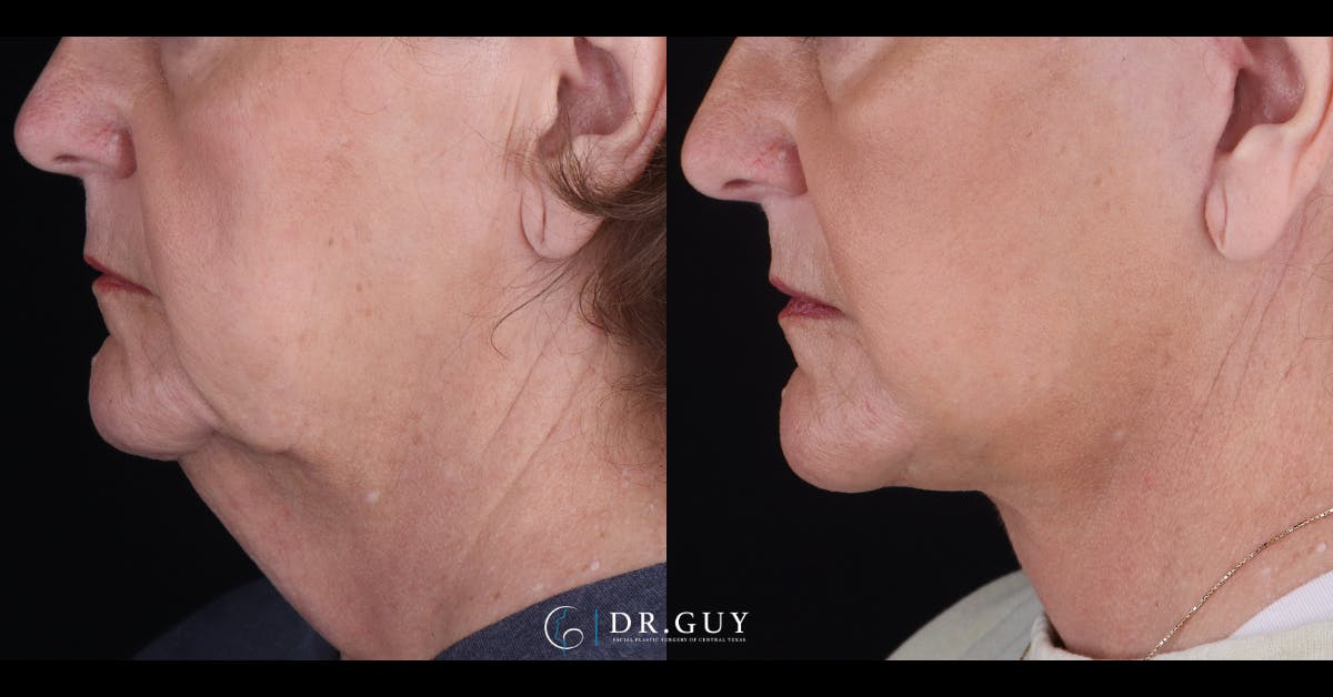 Facelift Before & After Gallery - Patient 847629 - Image 3