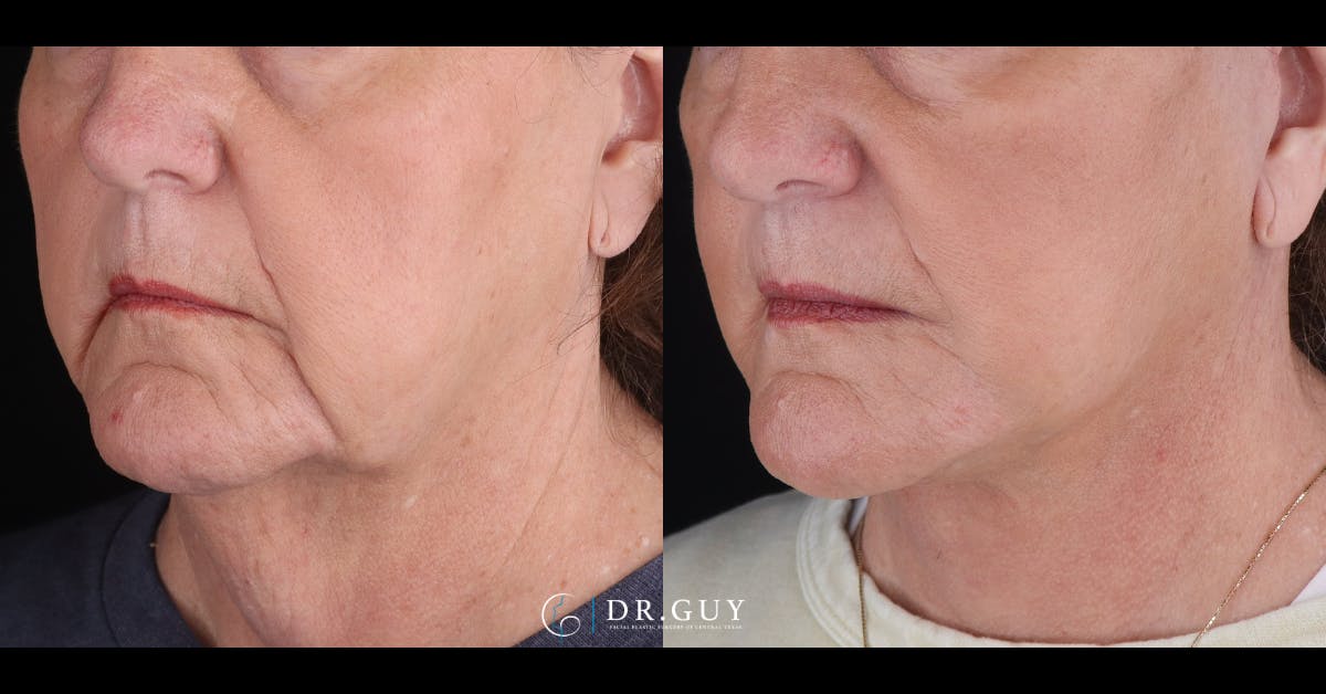 Facelift Before & After Gallery - Patient 847629 - Image 1