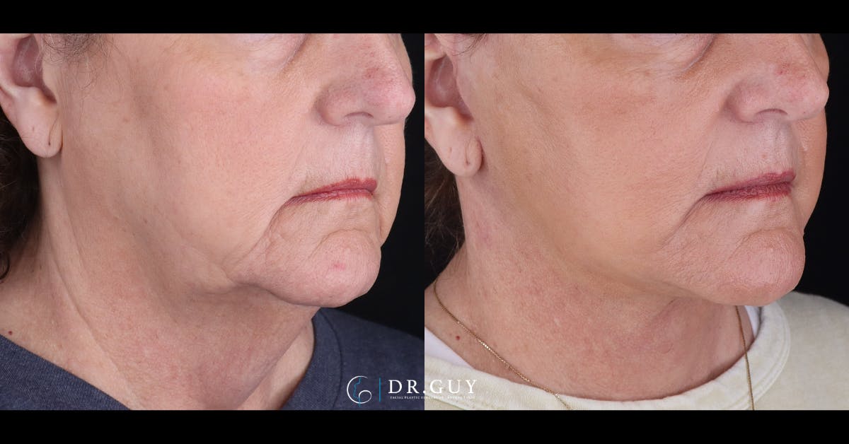 Facelift Before & After Gallery - Patient 847629 - Image 4