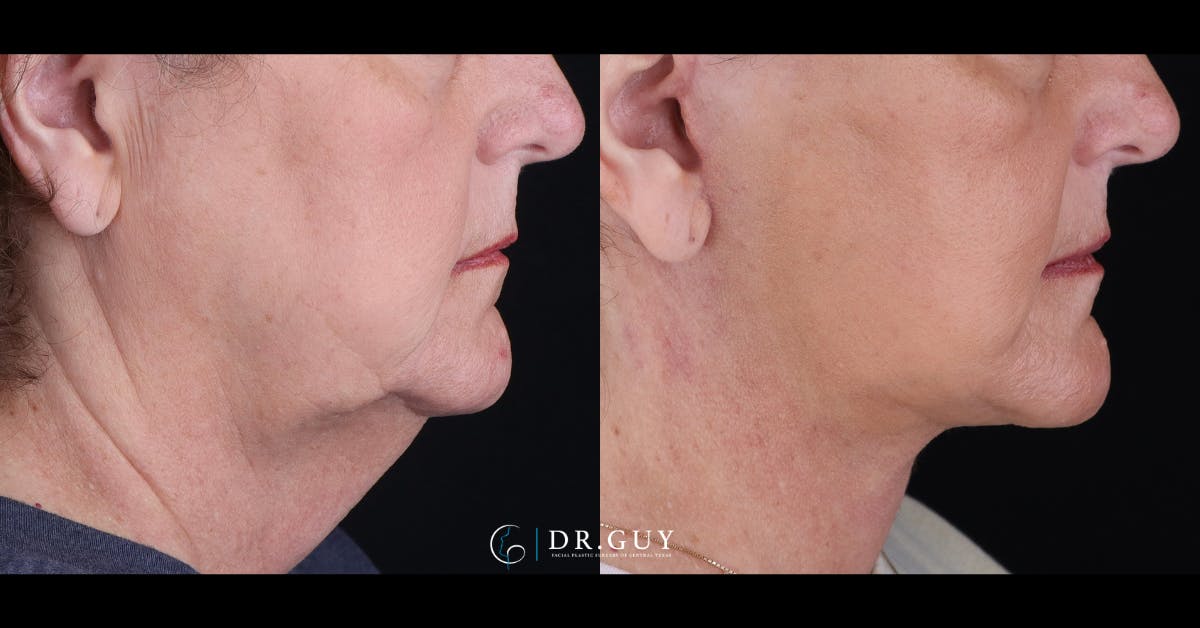 Facelift Before & After Gallery - Patient 847629 - Image 2