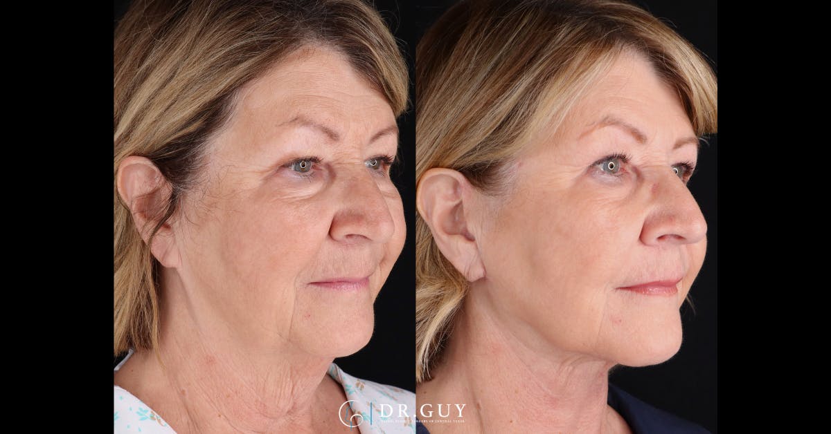 Neck Lift Before & After Gallery - Patient 901477 - Image 2