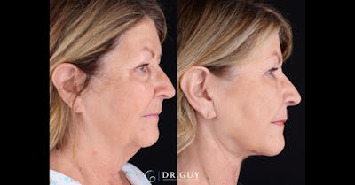 Neck Lift Before & After Gallery - Patient 901477 - Image 1