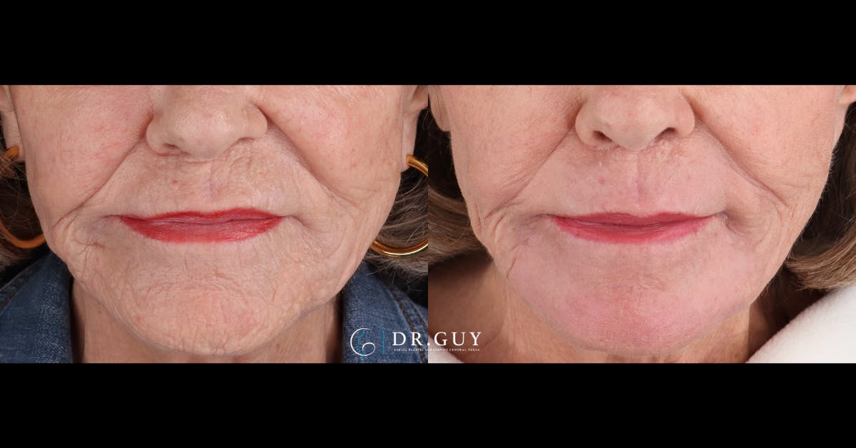 Laser Before & After Gallery - Patient 297455 - Image 2