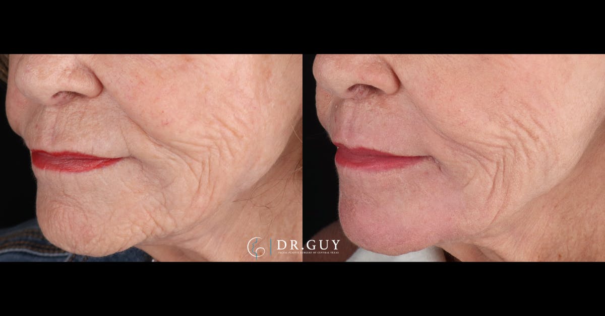 Laser Before & After Gallery - Patient 297455 - Image 3