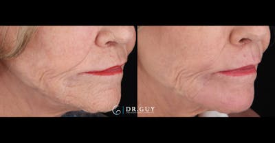 Laser Before & After Gallery - Patient 297455 - Image 1