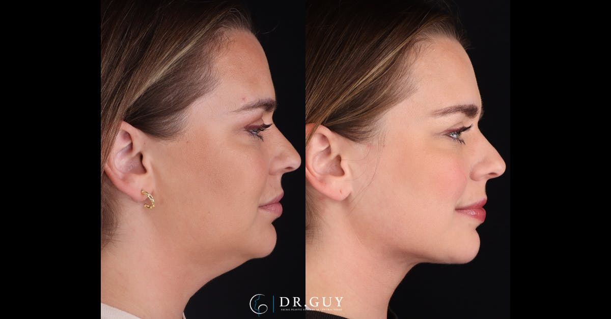 Platysmaplasty Before & After Gallery - Patient 531464 - Image 1