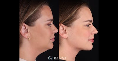 Platysmaplasty Before & After Gallery - Patient 531464 - Image 1