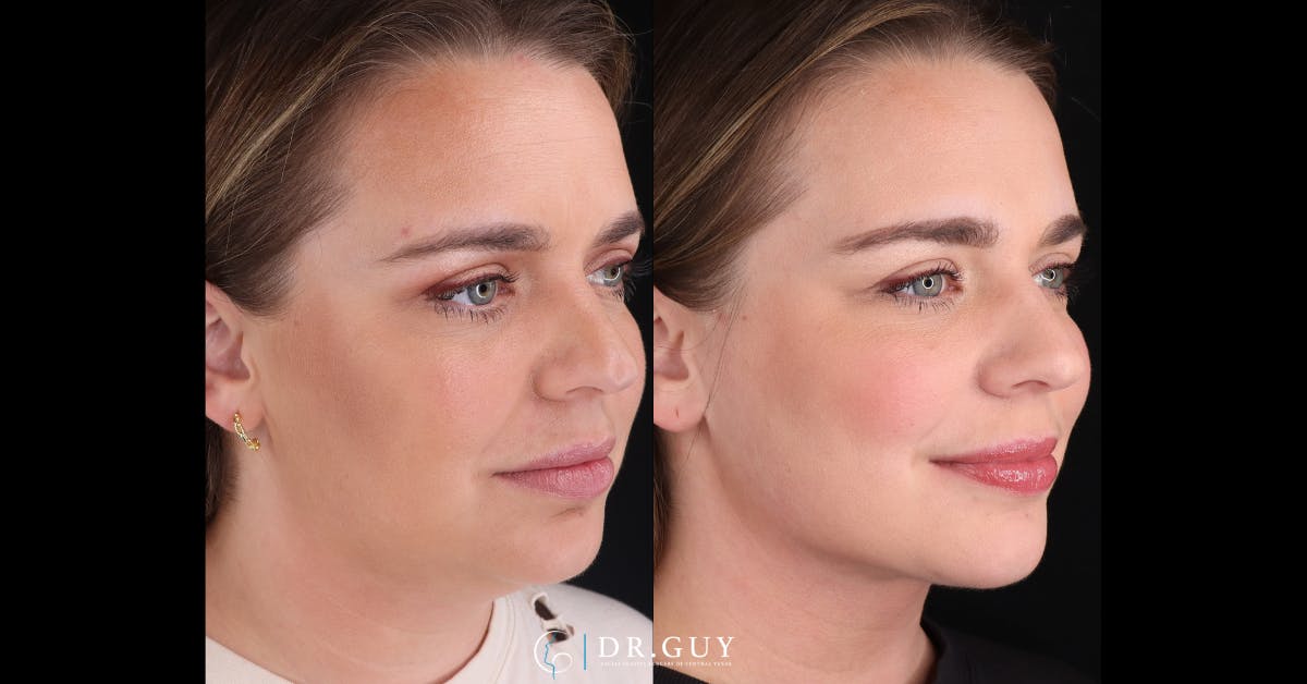 Platysmaplasty Before & After Gallery - Patient 531464 - Image 5