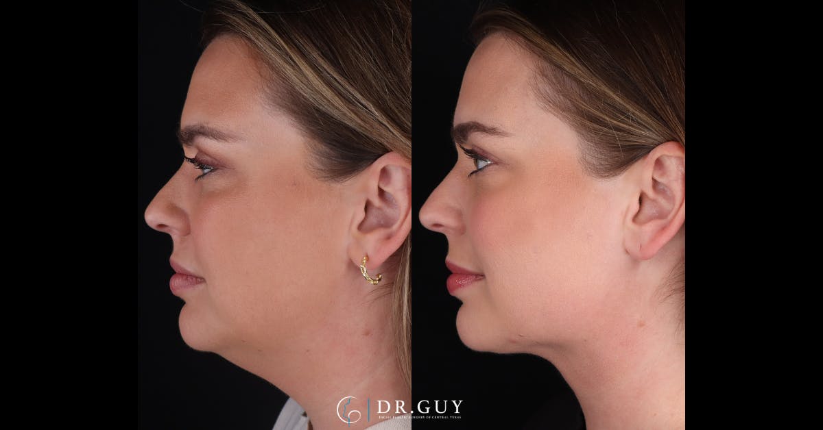 Platysmaplasty Before & After Gallery - Patient 531464 - Image 4