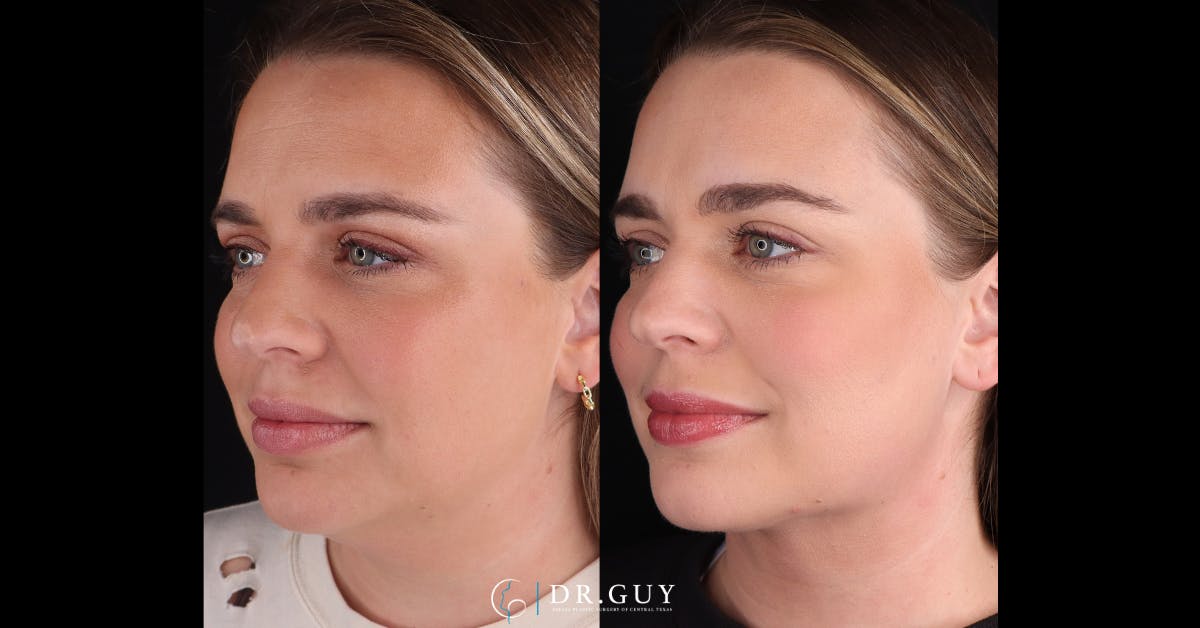 Platysmaplasty Before & After Gallery - Patient 531464 - Image 2