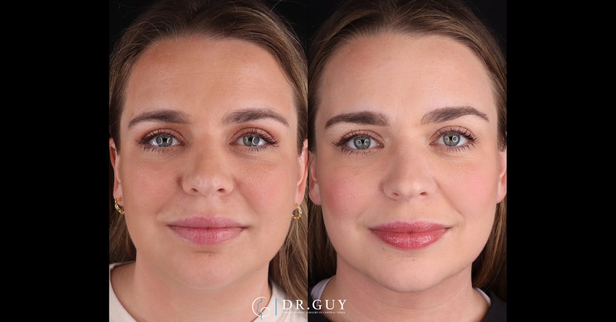 Platysmaplasty Before & After Gallery - Patient 531464 - Image 3