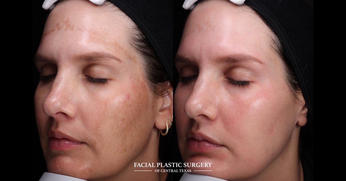 Laser Before & After Gallery - Patient 319920 - Image 1