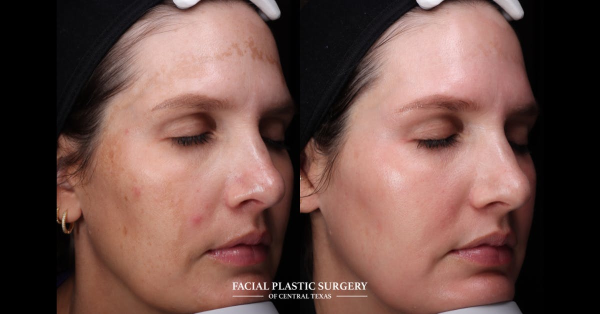Laser Before & After Gallery - Patient 319920 - Image 2