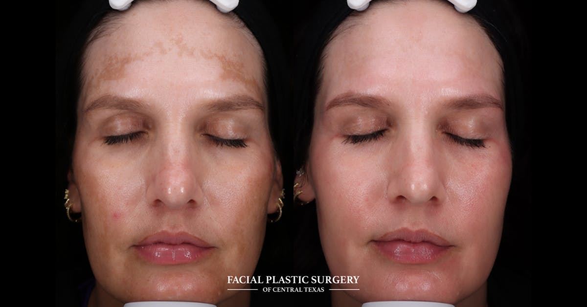 Laser Before & After Gallery - Patient 319920 - Image 3