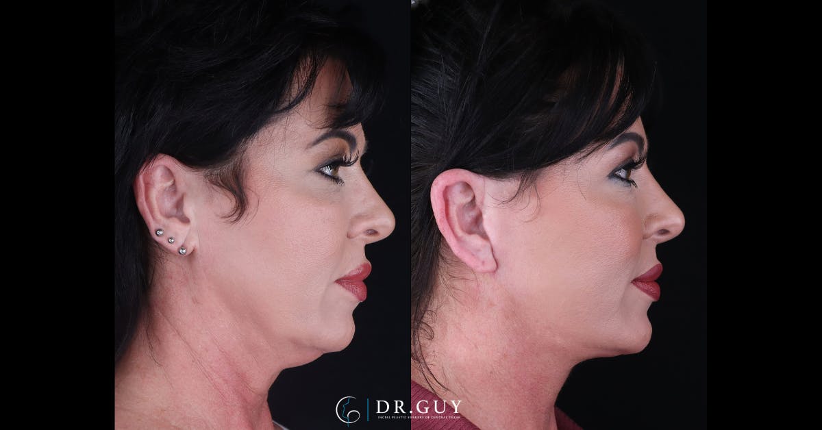 Facelift Before & After Gallery - Patient 227184 - Image 2