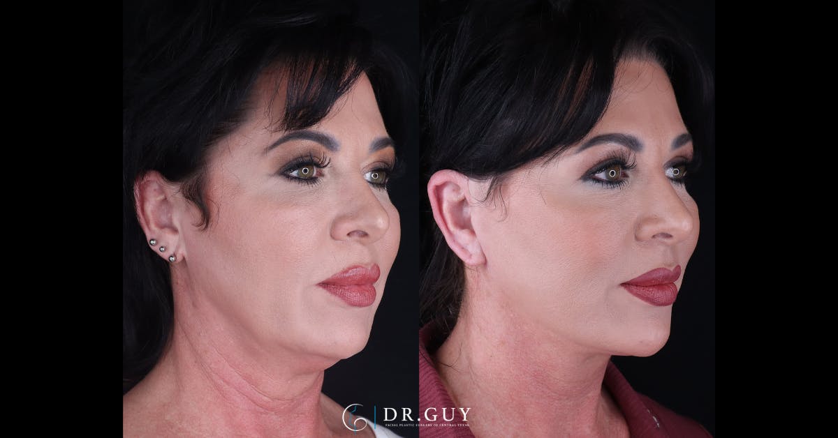 Facelift Before & After Gallery - Patient 227184 - Image 4