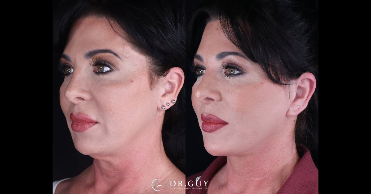 Facelift Before & After Gallery - Patient 227184 - Image 1