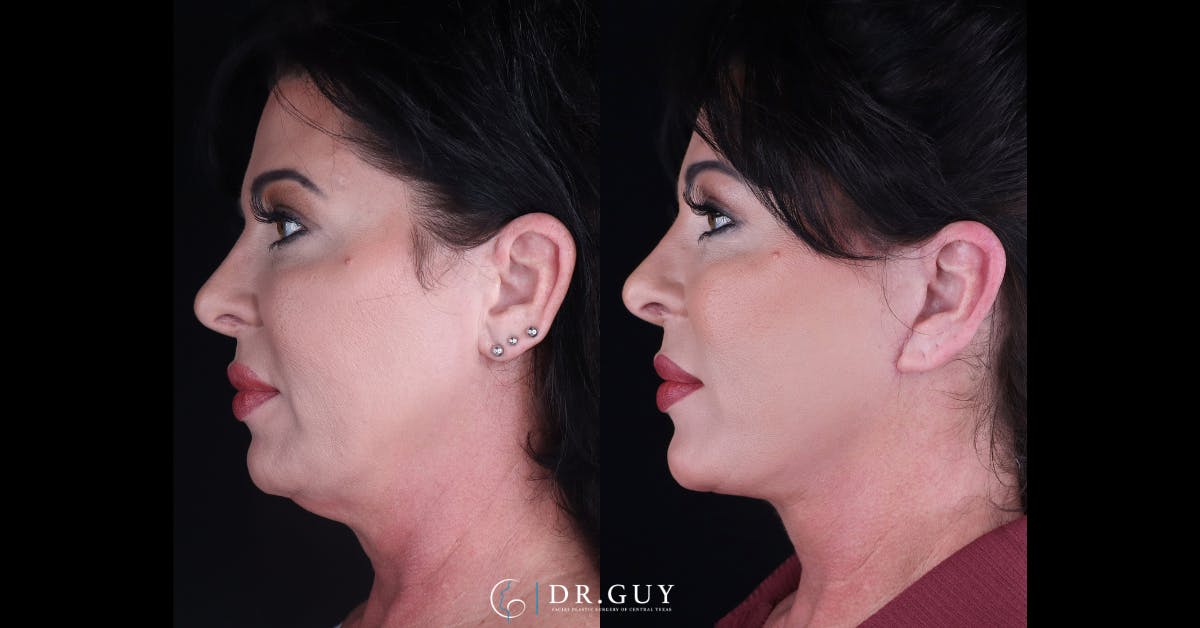 Facelift Before & After Gallery - Patient 227184 - Image 3
