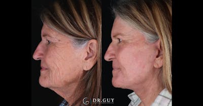 Facelift Before & After Gallery - Patient 251575 - Image 1