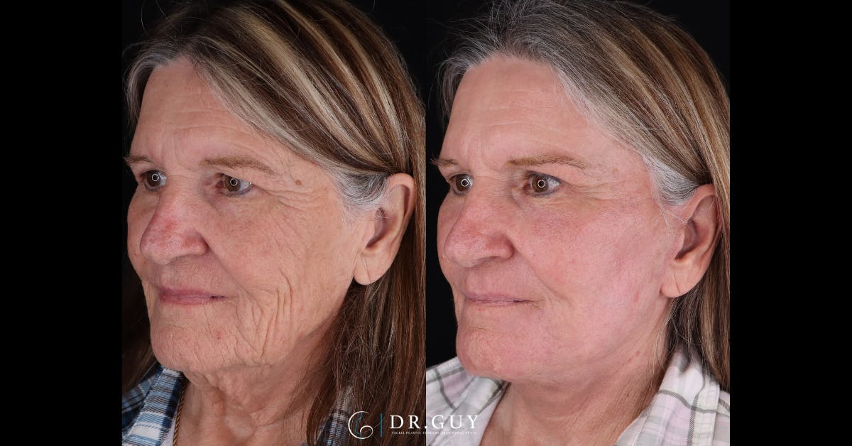 Facelift Before & After Gallery - Patient 251575 - Image 4