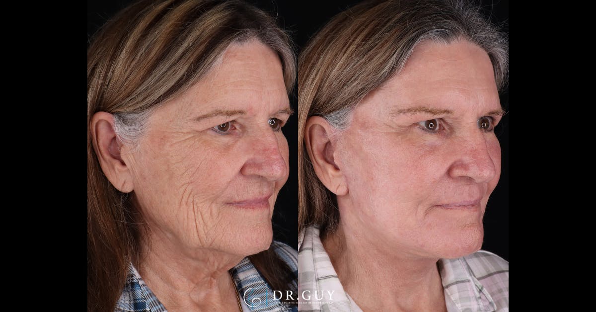 Facelift Before & After Gallery - Patient 251575 - Image 5