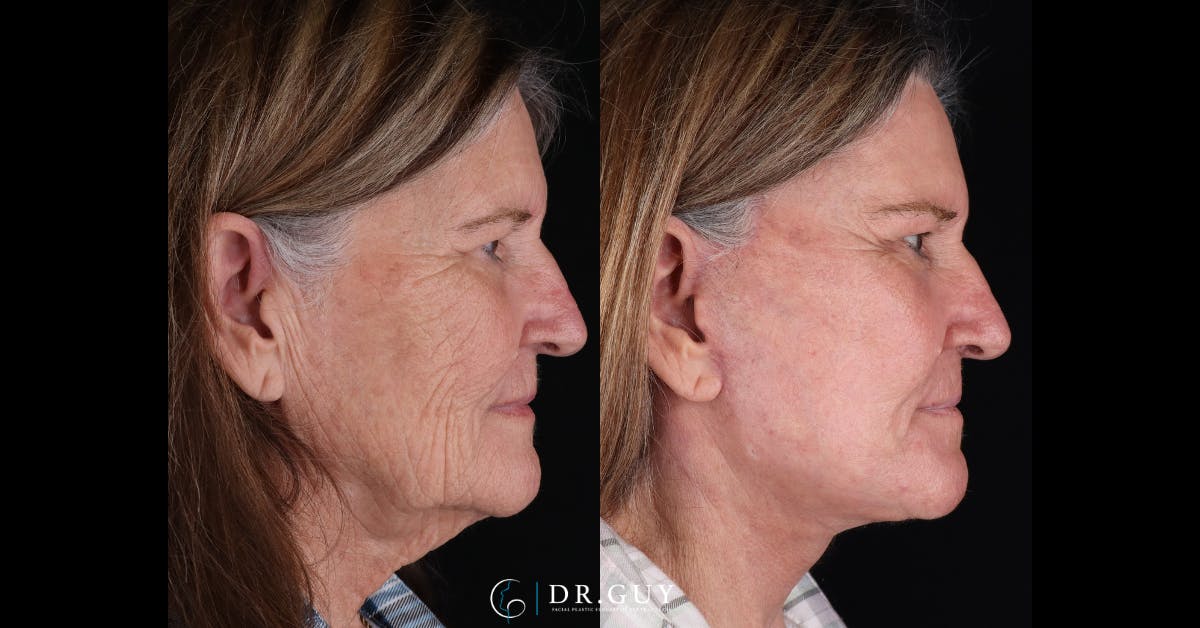 Facelift Before & After Gallery - Patient 251575 - Image 2