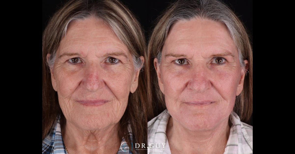 Facelift Before & After Gallery - Patient 251575 - Image 3