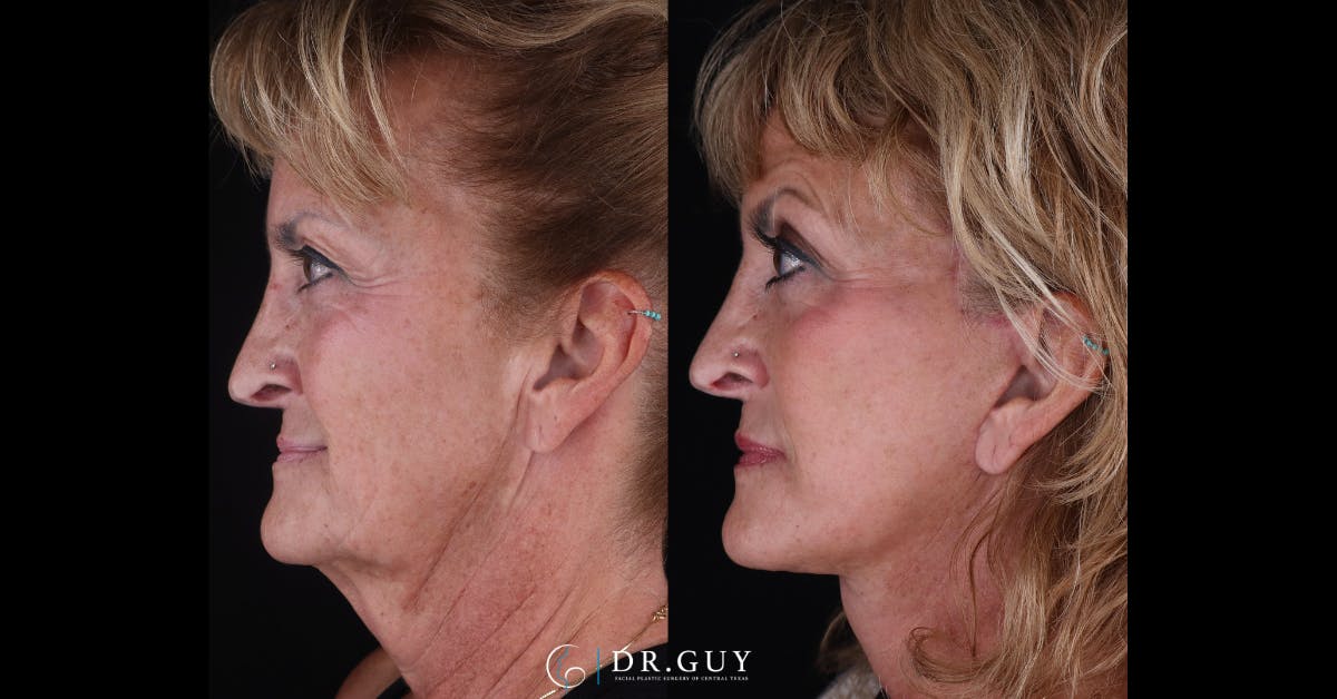 Facelift Before & After Gallery - Patient 405219 - Image 5