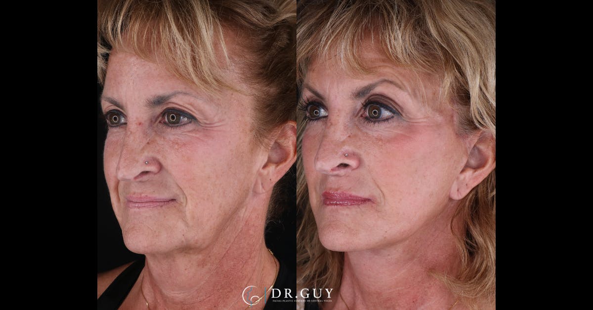 Facelift Before & After Gallery - Patient 405219 - Image 3