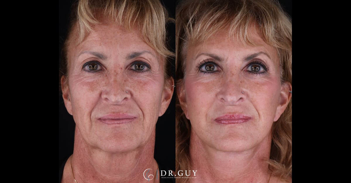 Facelift Before & After Gallery - Patient 405219 - Image 2