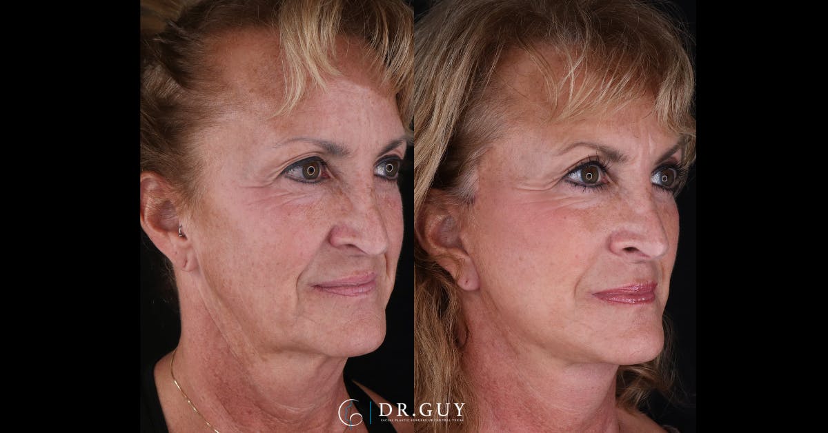 Facelift Before & After Gallery - Patient 405219 - Image 1
